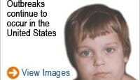 mumps